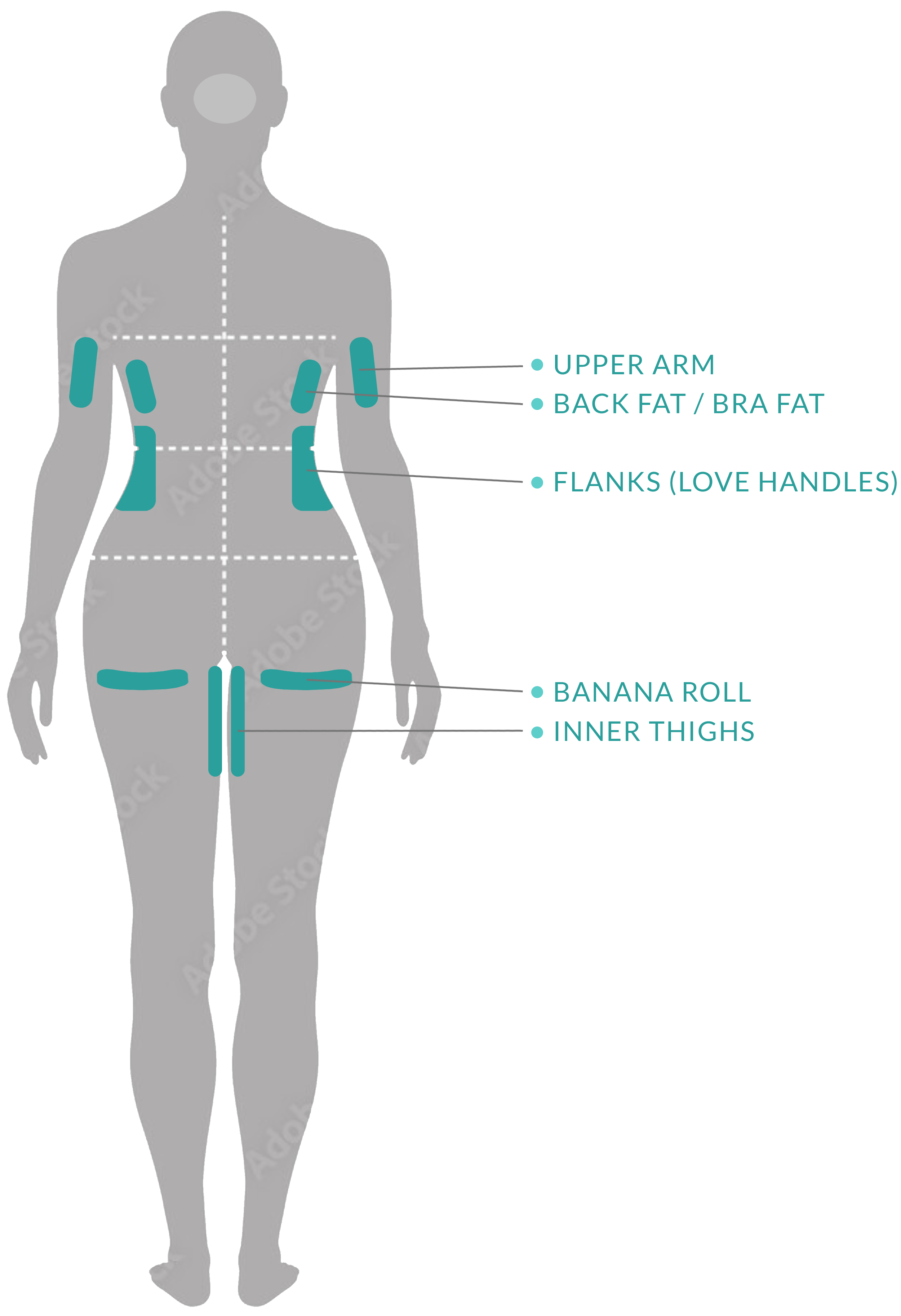Diagram of female back showing body zones targeted by CoolSculpting: Upper Arms, Back Fat / Bra Fat, Flank (Love Handles), Banana Roll, and Inner Thighs