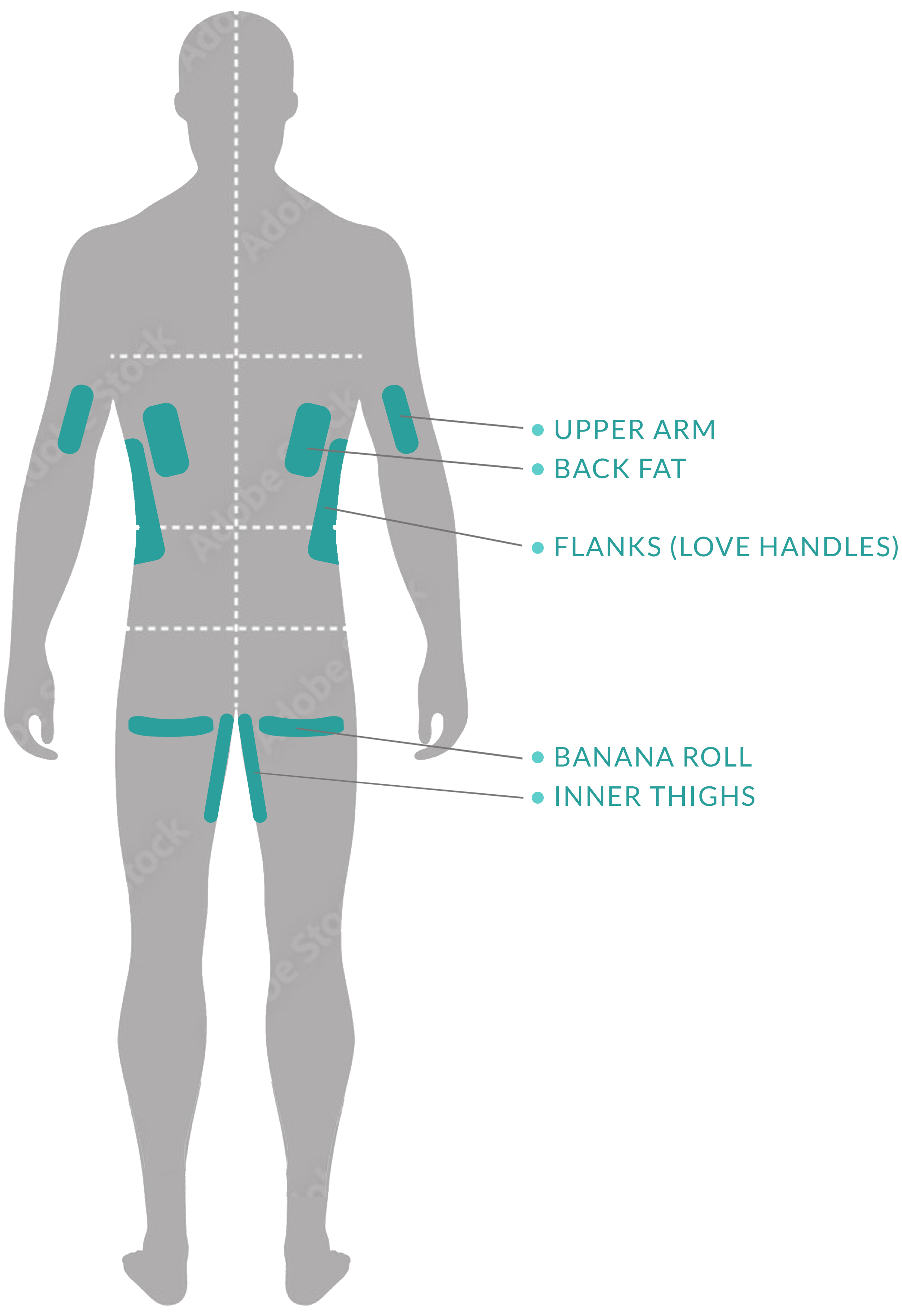 Diagram of male back showing body zones targeted by CoolSculpting: Upper Arms, Back Fat, Flank (Love Handles), Banana Roll, and Inner Thighs