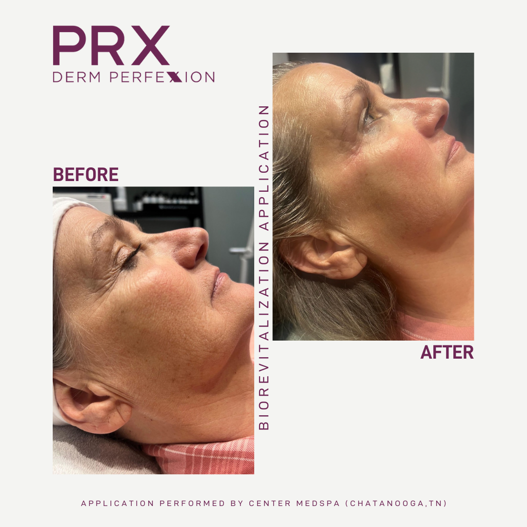 PRX before after 1