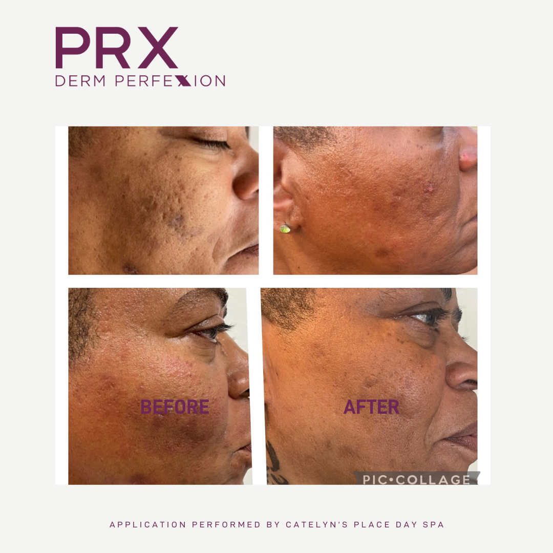 prx before and after 4
