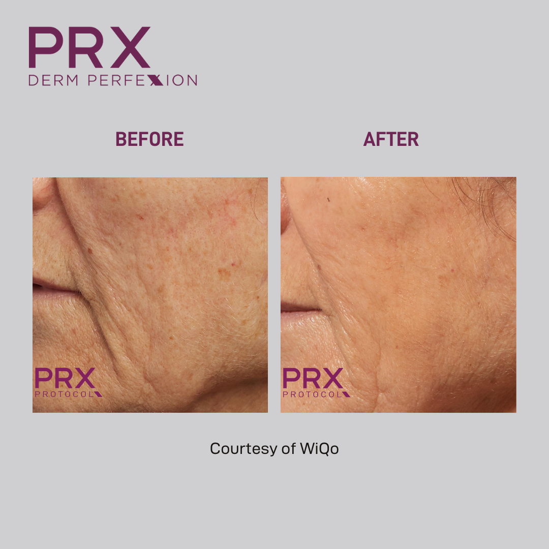 prx before and after 6